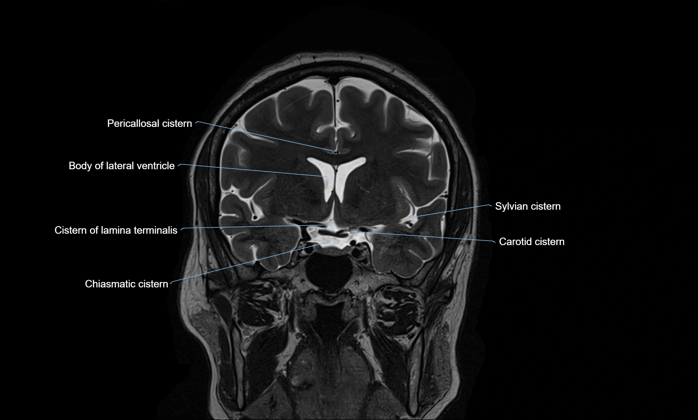 Brain cisterns  and ventricles coronal anatomy 3T MRI image-img-00001-00021.webp